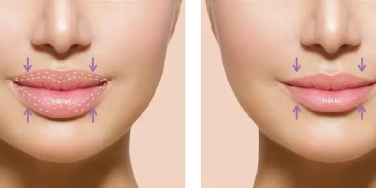 How Lip Reduction in Islamabad Improves Confidence